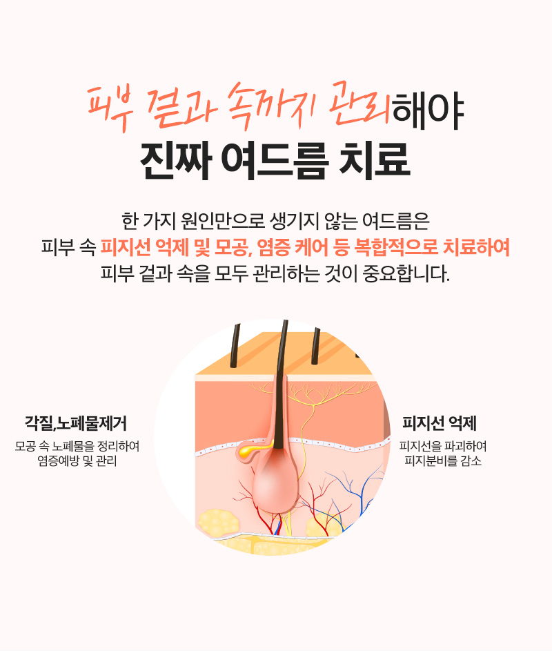 리엔장 여드름케어 치료방법