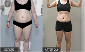 리엔장 1인치플러스 시술 전후 사진 01