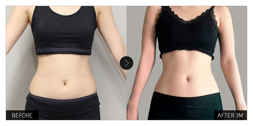 리엔장 1인치플러스 시술 전후 사진 02