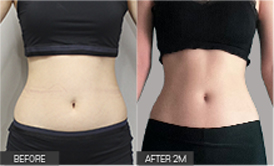 리엔장 1인치플러스 시술 전후 사진 02