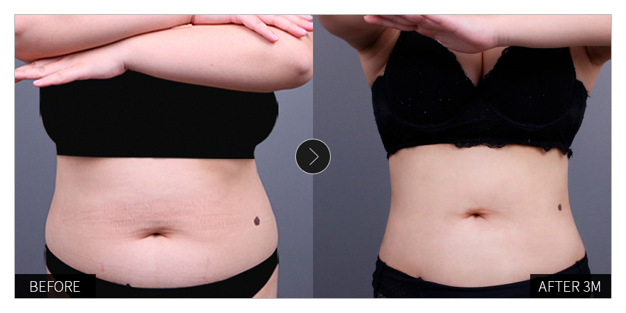 리엔장 1인치플러스 시술 전후 사진 03