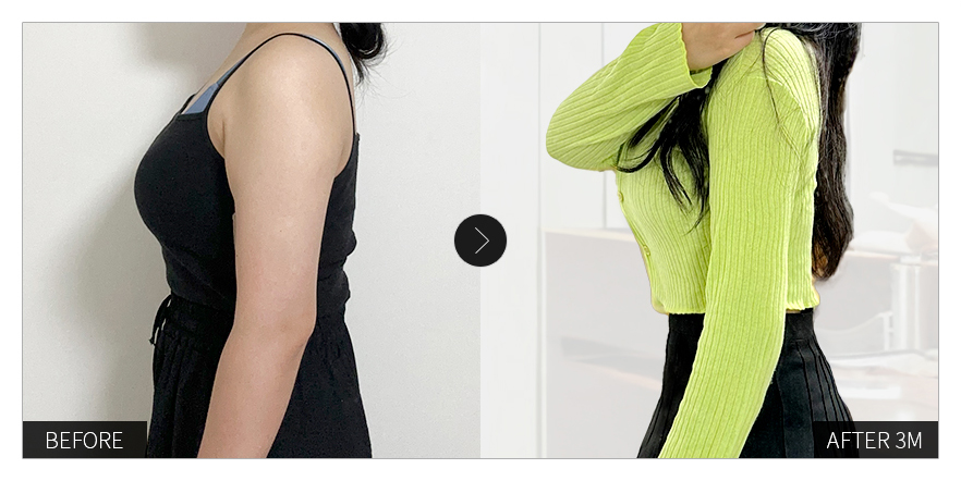 리엔장 1인치플러스 시술 전후 사진 04