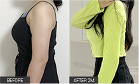 리엔장 1인치플러스 시술 전후 사진 04