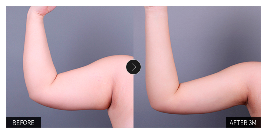 리엔장 1인치플러스 시술 전후 사진 05