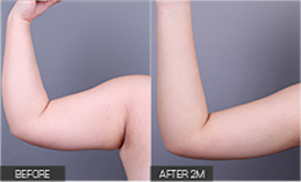 리엔장 1인치플러스 시술 전후 사진 05