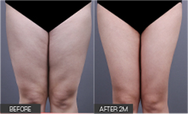 리엔장 1인치플러스 시술 전후 사진 06