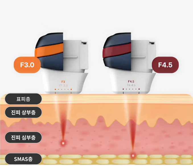 올리지오Kiss 초음파 혁신적 듀얼모드: 진피 상하부 동시 타깃 인포그래픽
