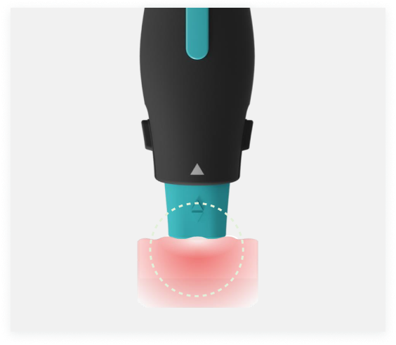 올리지오X 실시간 온도 체크 및 진동 기술 적용 시술 컷