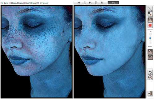 Meta Vu 가상 레이저 시술 이미지