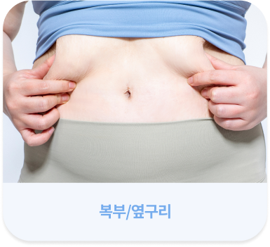 살빼주사 시술 부위 안내 이미지 허벅지